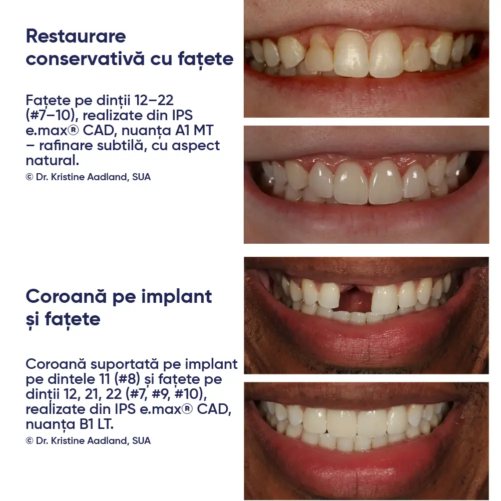 restaurari realizate cu IPS e.max CAD cerec si informatii
