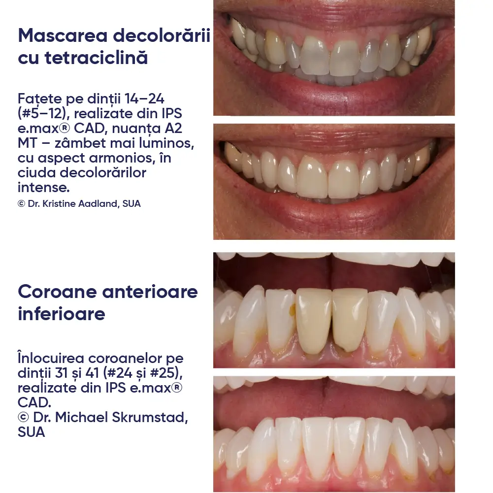 restaurari realizate cu IPS e.max CAD cerec si informatii despre acestea