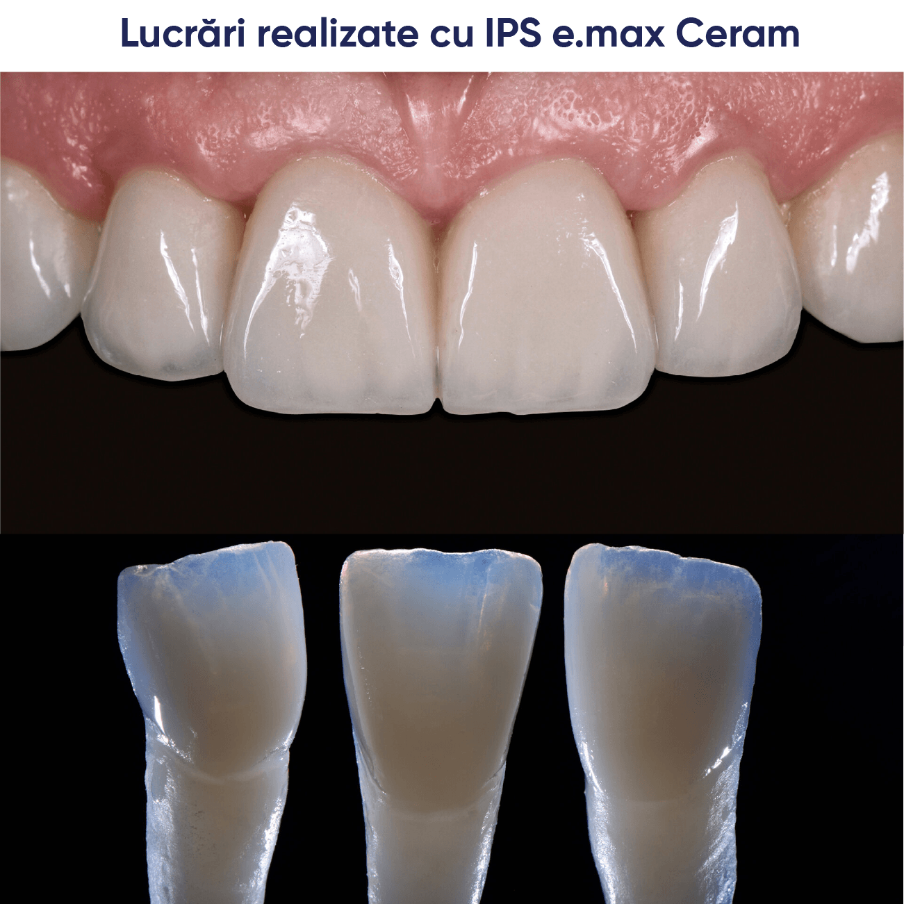 prezentare lucrari realizate cu ceramica IPS e.max ceram in laboratorul de tehnica dentara
