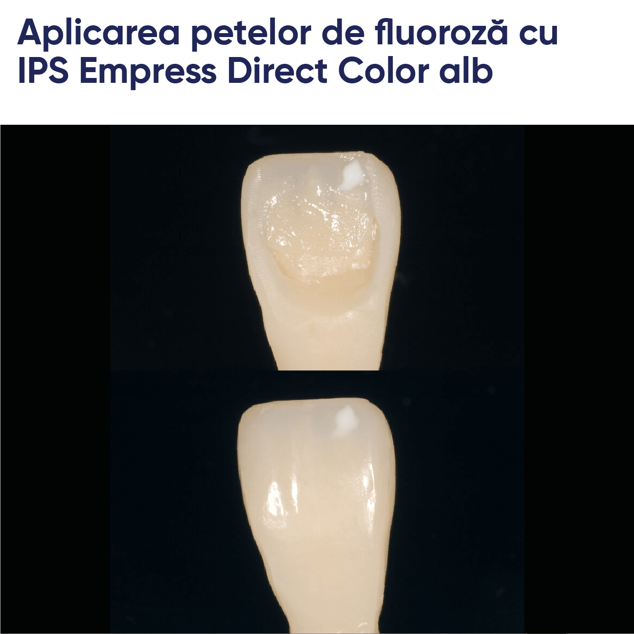 aplicarea petelor cu materialul de umplere din compozit fotopolimerizabil IPS empress direct