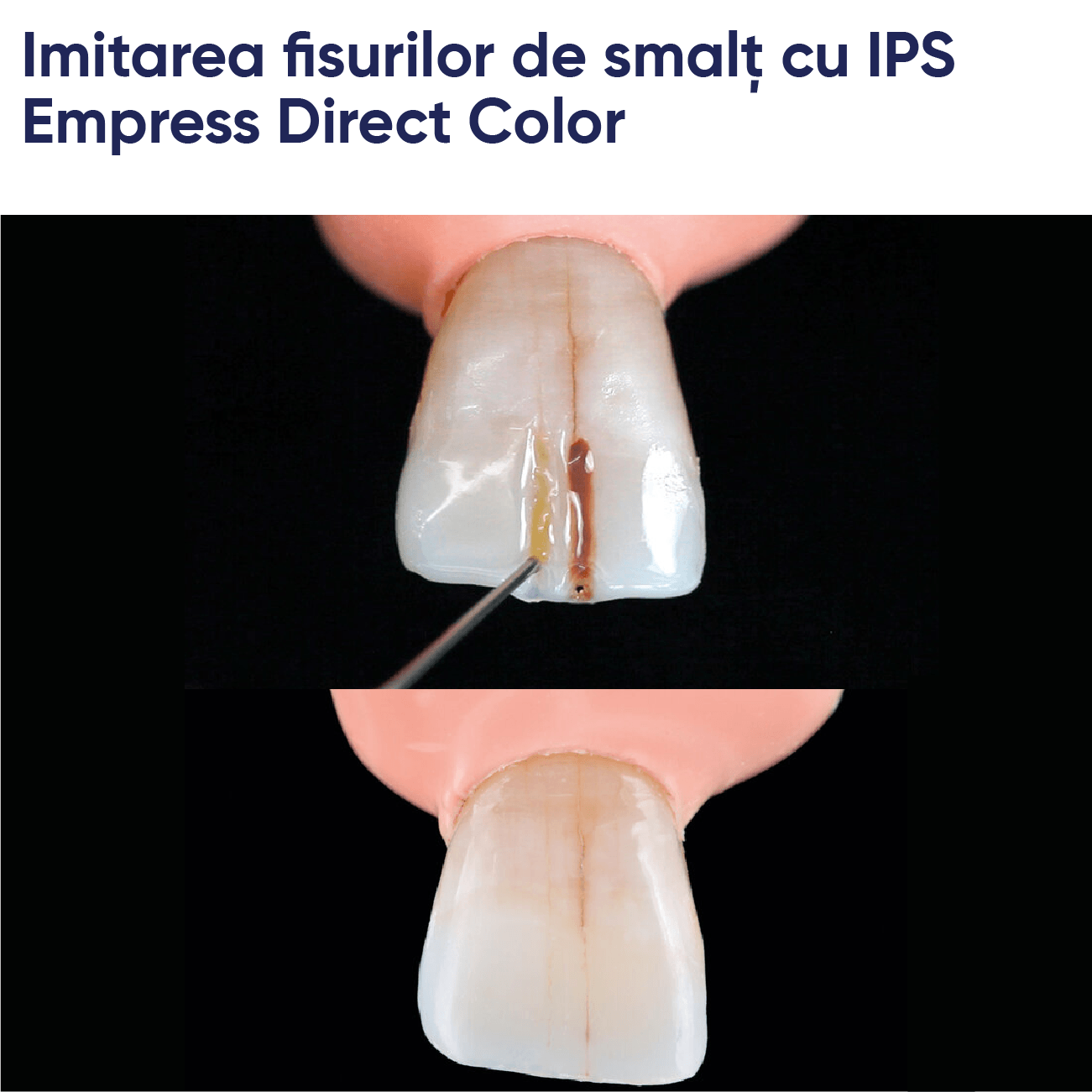 colorare realizata cu materialul de umplere din compozit fotopolimerizabil IPS empress direct