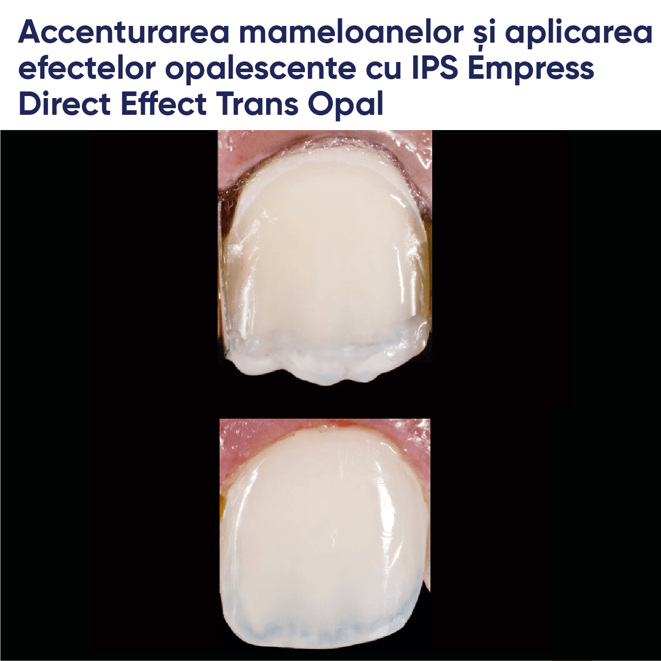 restaurare realizata cu materialul de umplere din compozit fotopolimerizabil IPS empress direct