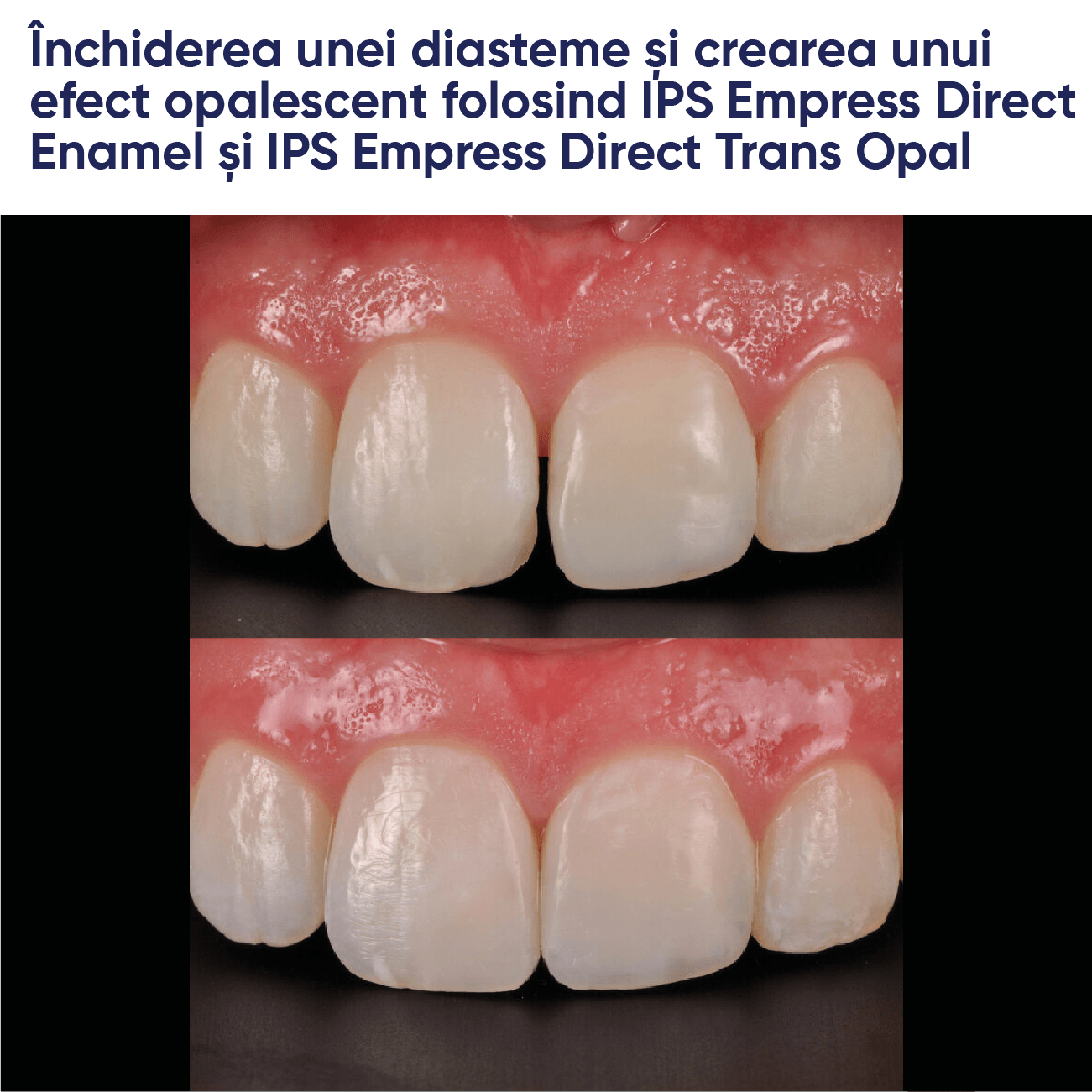 exemplu de restaturare realizata cu materialul de umplere din compozit fotopolimerizabil IPS empress direct