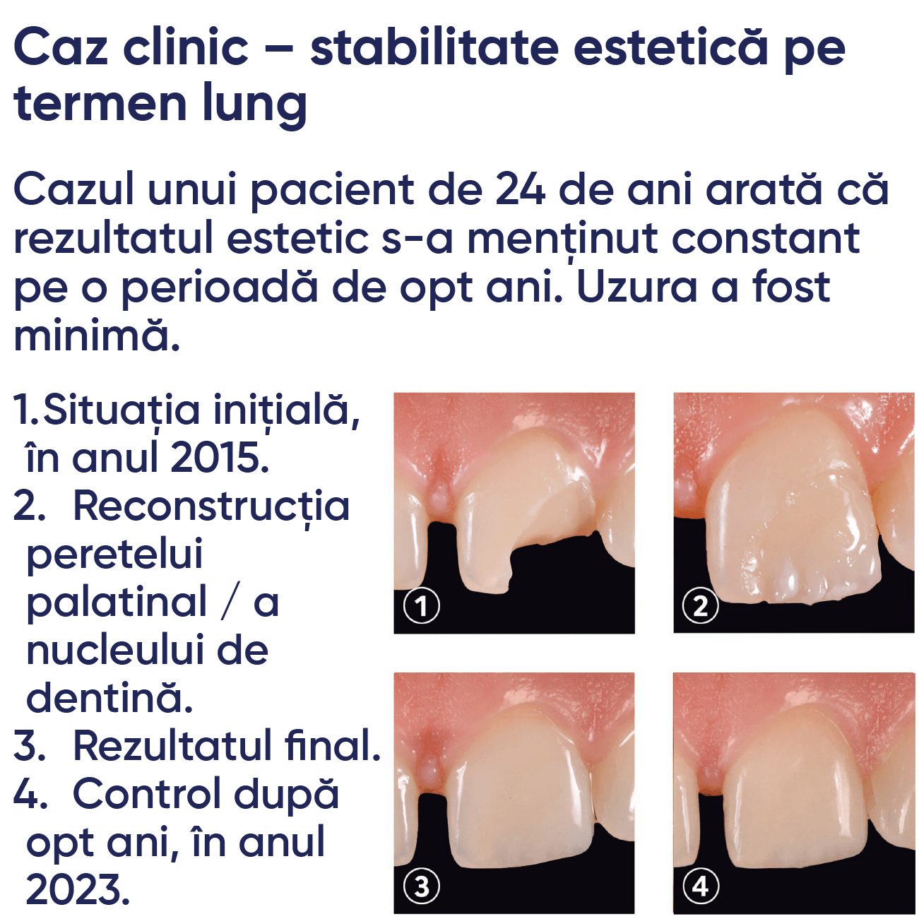 pasii pentru un caz clinic realizat cu materialul de umplere din compozit fotopolimerizabil IPS empress direct