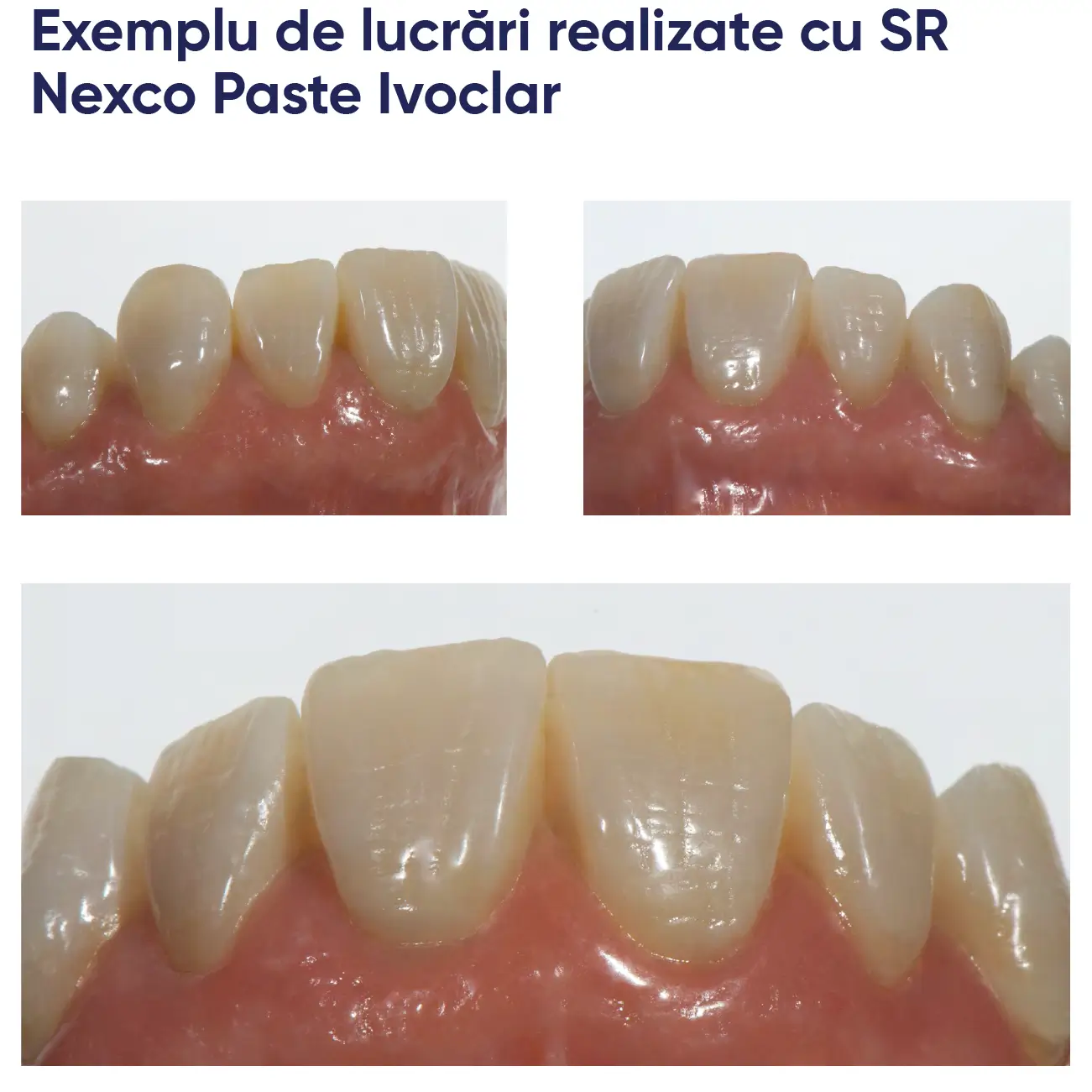 mai multe exemple de lucrări realizate cu paste SR Nexco paste Ivoclar