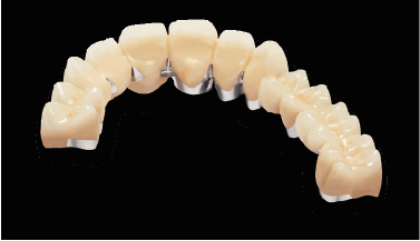 Exemplu de lucrare cu Wiron Light in laboratorul dentar