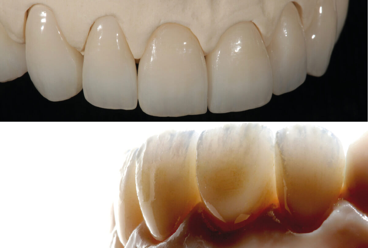 lucrari estetice realizate cu ceramica ivoclar ips ivocolor