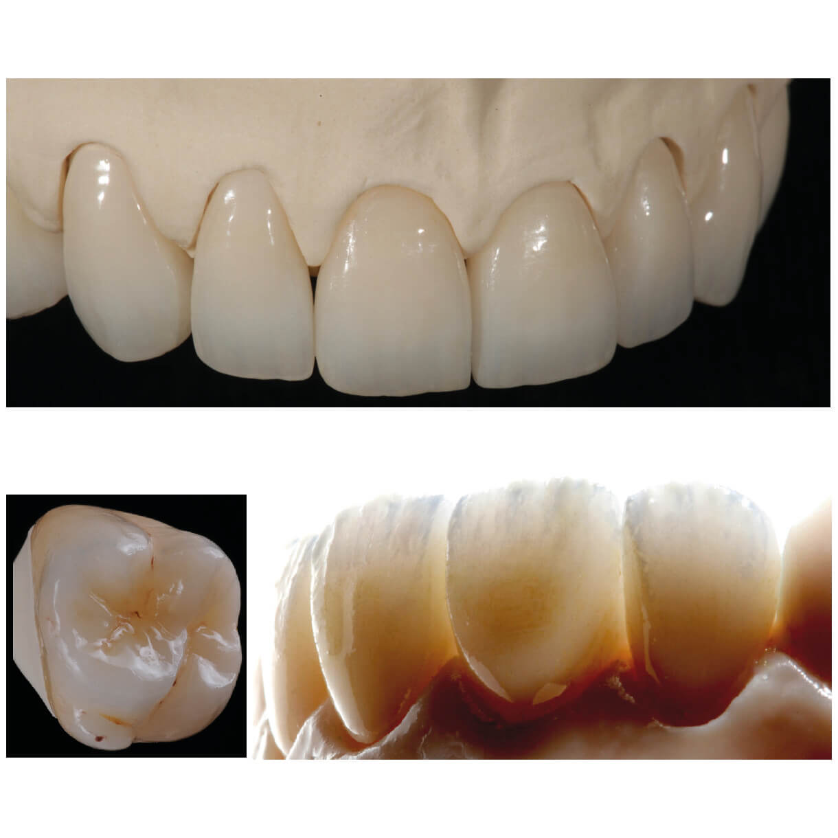 lucrari estetice realizate cu ceramica ivoclar ips ivocolor