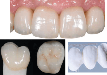 lucrari dentare realizate cu ceramica ips style ceram