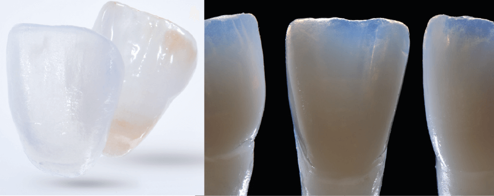 fatete realizate cu ceramica IPS e.max ceram