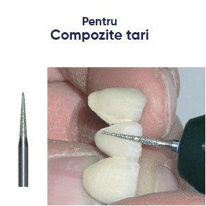 freze diamantate tip efilate, exemplu de lucrare. Freze dentare pentru compozite tari