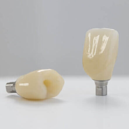 lucrare pe implant realizata cu ceramica IPS e.max CAD