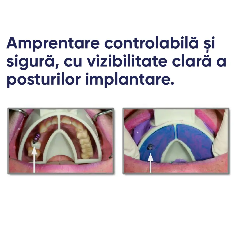 exemplu de utilizare in cabinetul stomatologic a unei linguri de amprenta miratray implant
