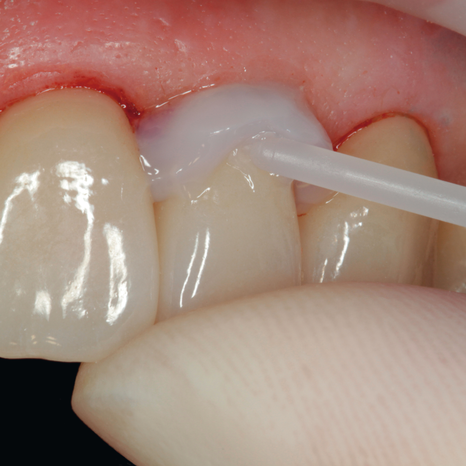 utilizare pasta liquid strip in cabinetul dentar
