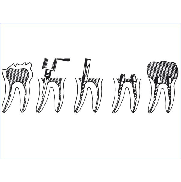 pivoti endodontici mira-post