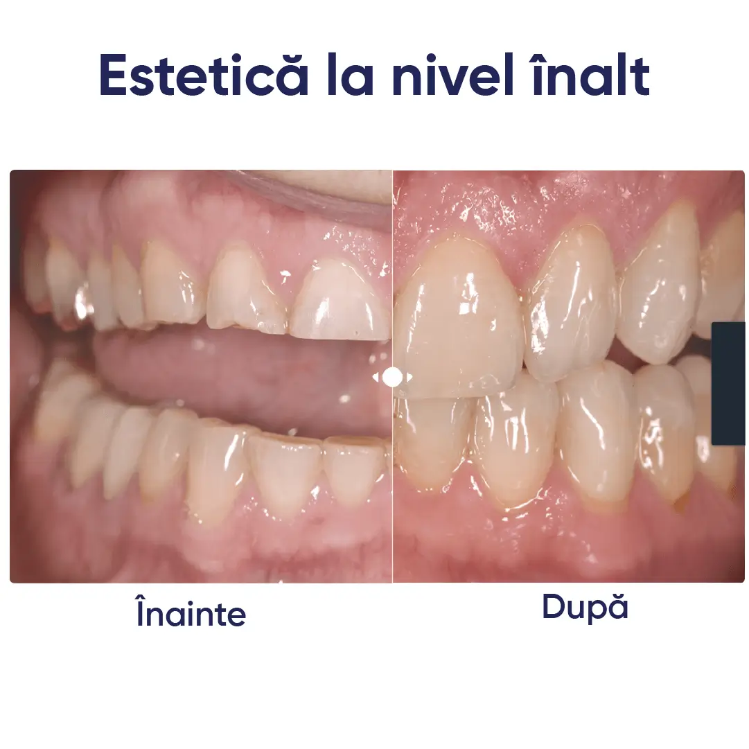 exemplu de restaurare realizata cu ingotul de ceramica celtra press dentsply sirona