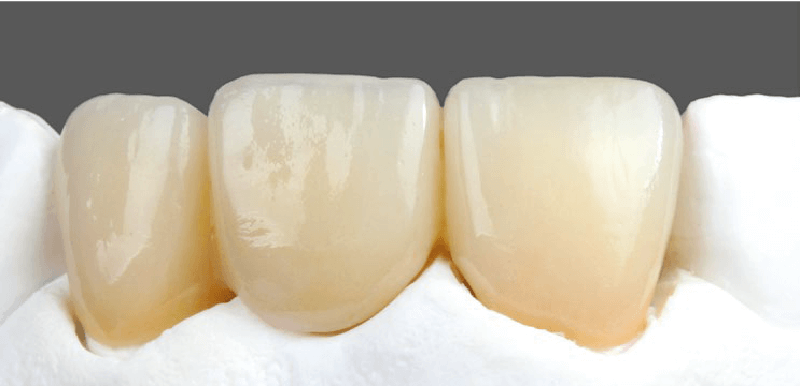 lucrare realizata cu ceramica cercon ceram kiss