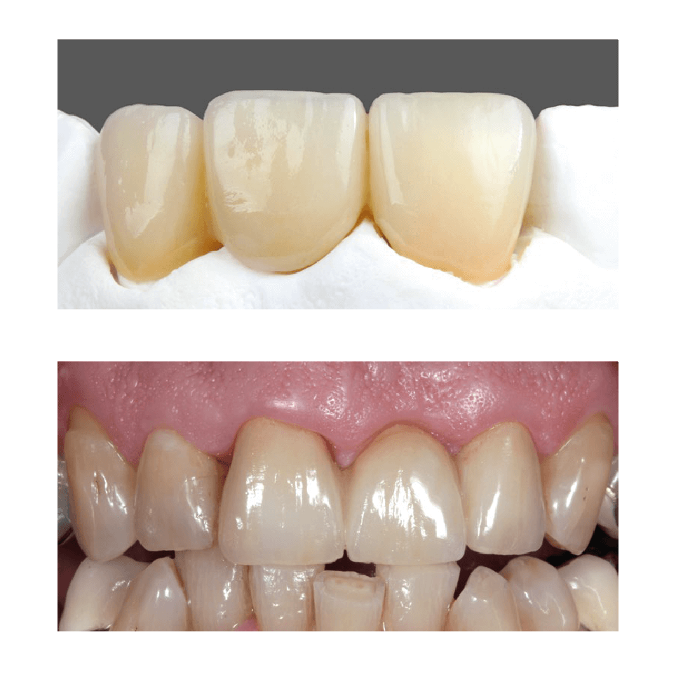 lucrari realizate cu ceramica cercon ceram kiss