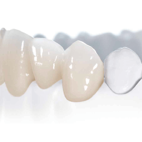 lucrare executata cu ceramica celtra ceram