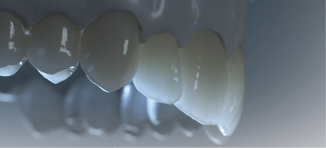 lucrare facuta cu ceramica celtra ceram vazuta din lateral