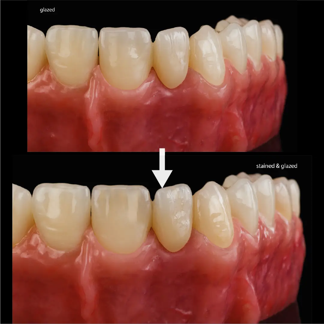 exemplu de lucrare finalizata realizata cu discul de zirconiu cercon xt ml dentsply sirona