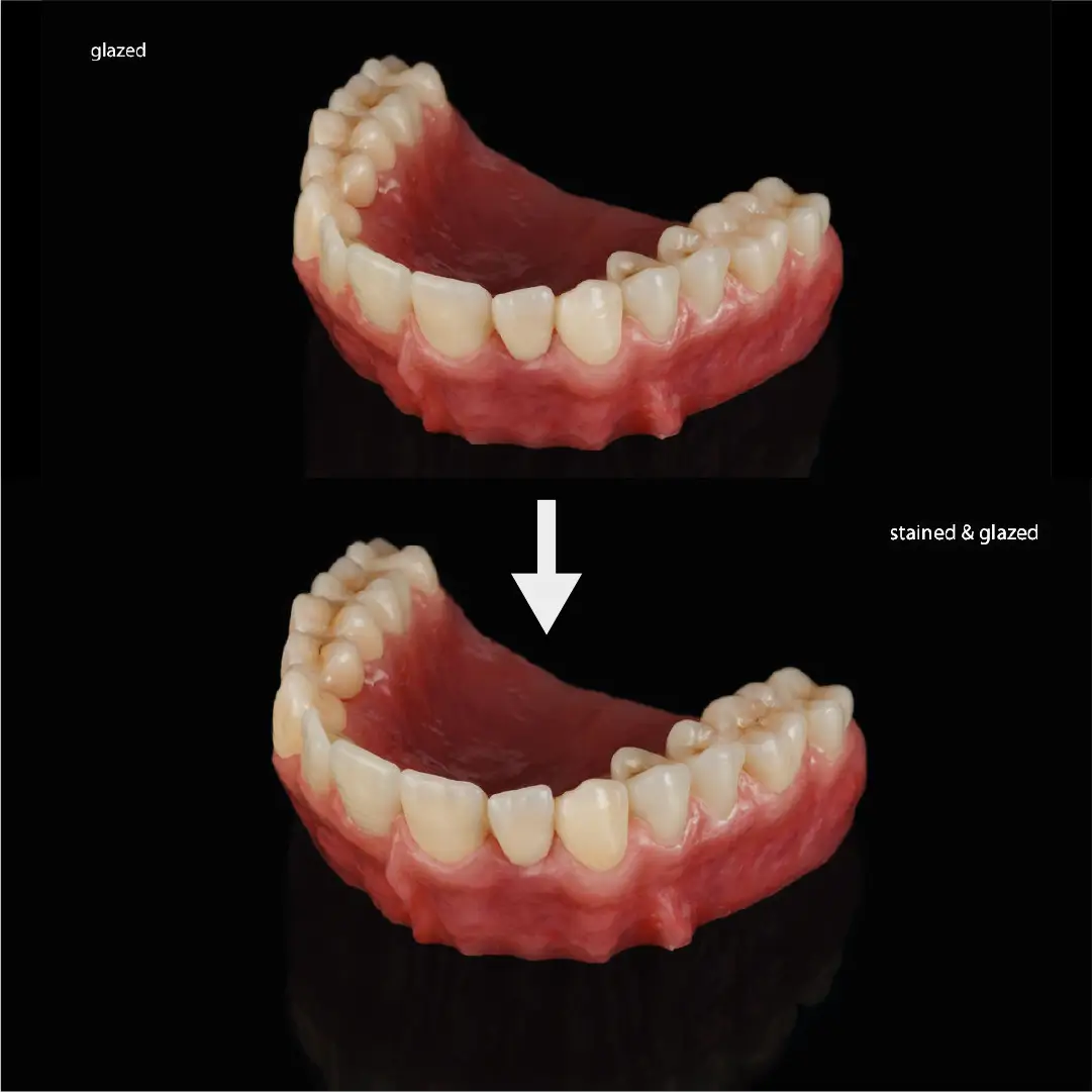 exemplu de finisare a lucrarii realizate cu cercon xt ml dentsply sirona