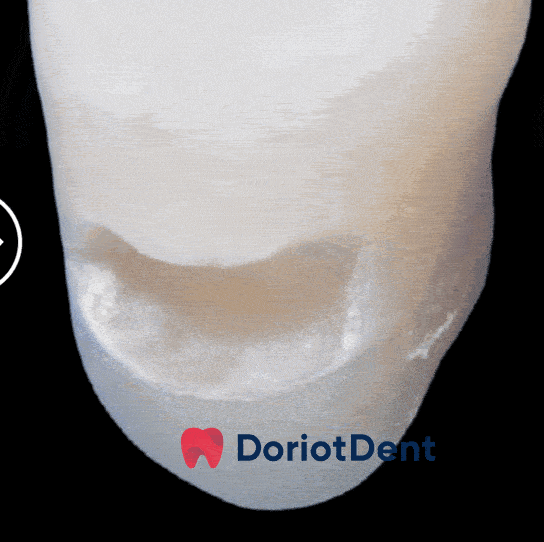 Ciment ionomer Harvard Dental IonoGlass Fill extra inainte de restaurare si dupa
