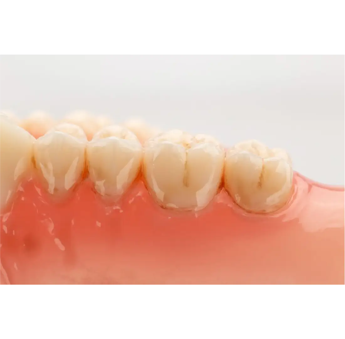 dinti printat 3D cu rasina VarseoSmile bego de aproape