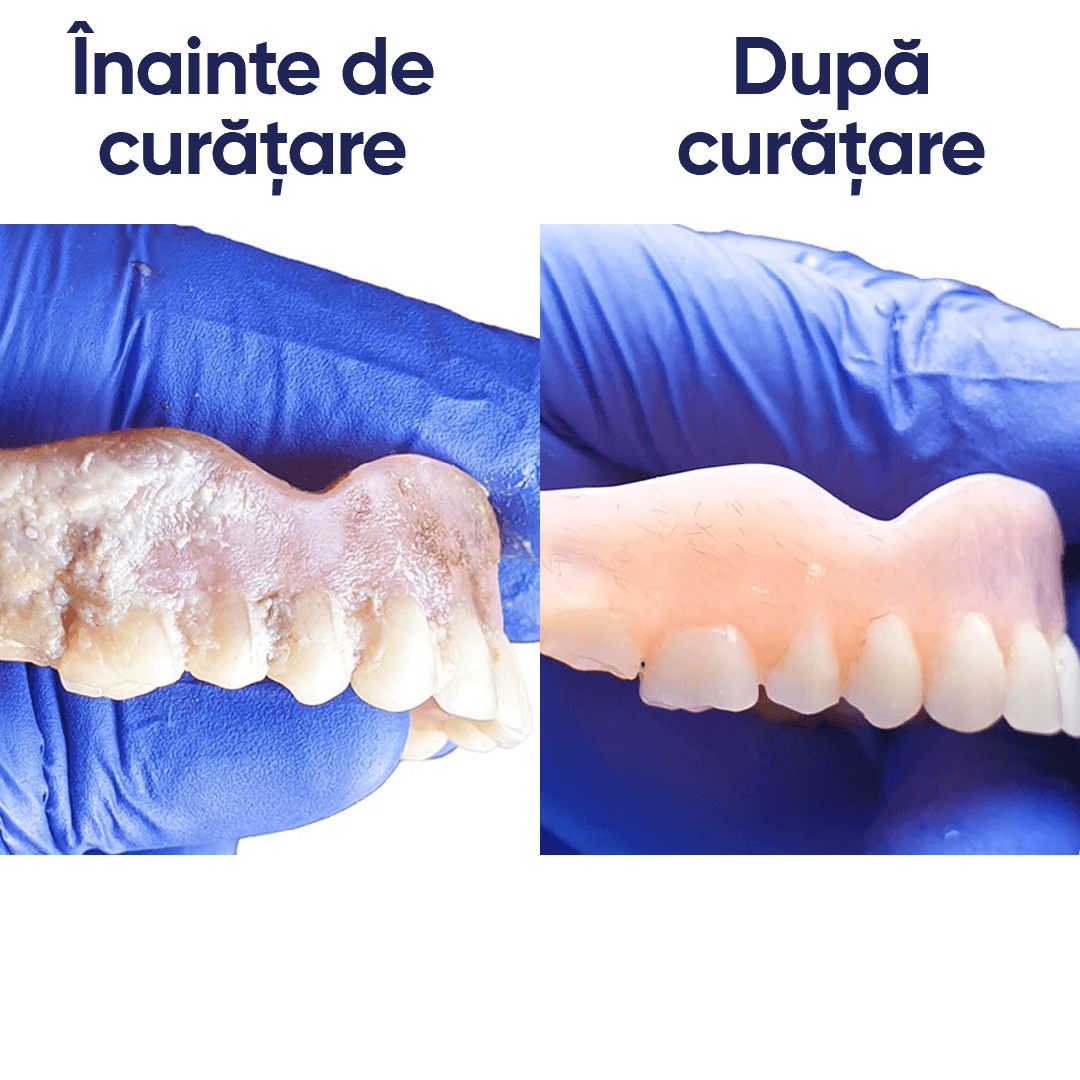 exemplu de utilizare aparat de curatare proteza sympro