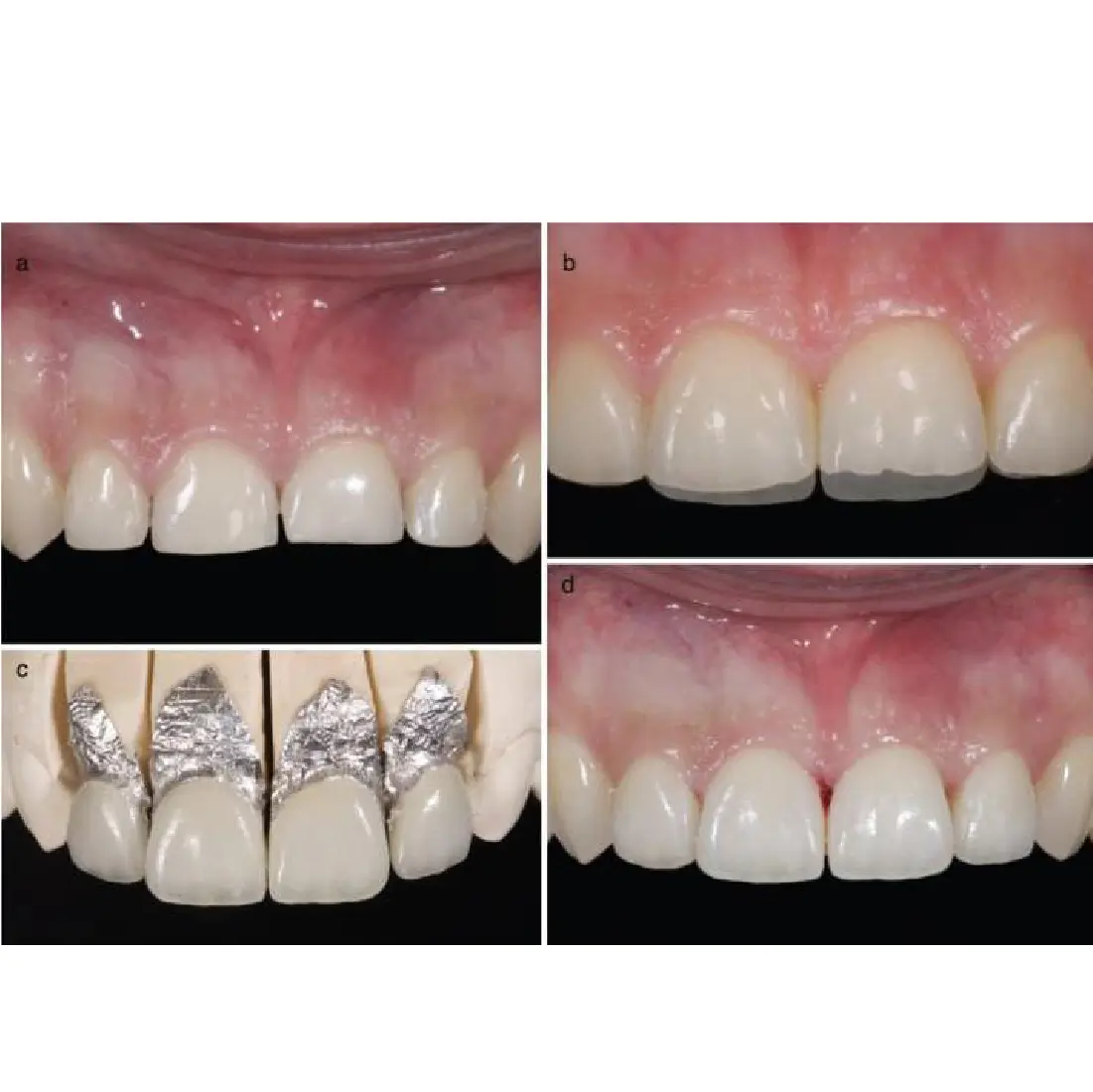 exemplu de utilizare in laborator de tehnica dentara a foliei de platina pentru fatete