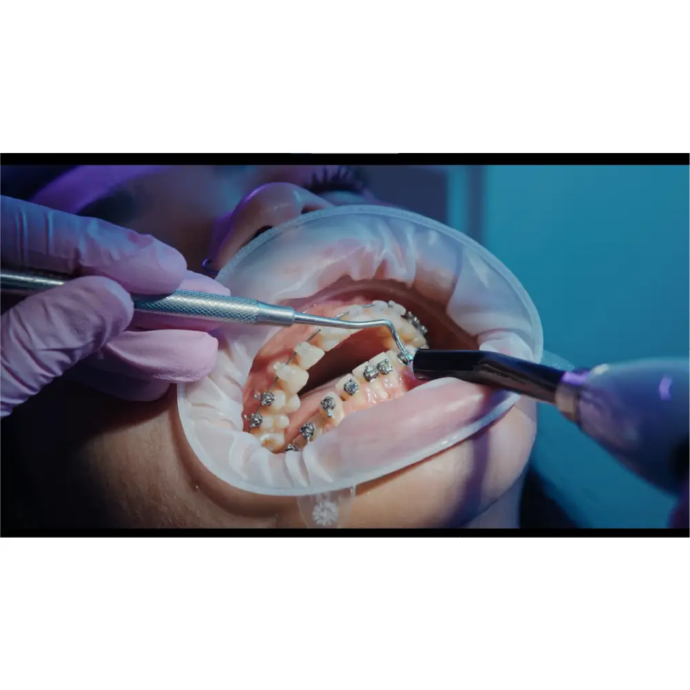 exemplu de lucrare in gura a unui pacient in timp ce poarta optragate ivoclar