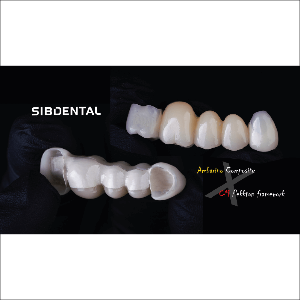 ceramica hibrida ambarino in utilizare cu lucrare laborator sibdental