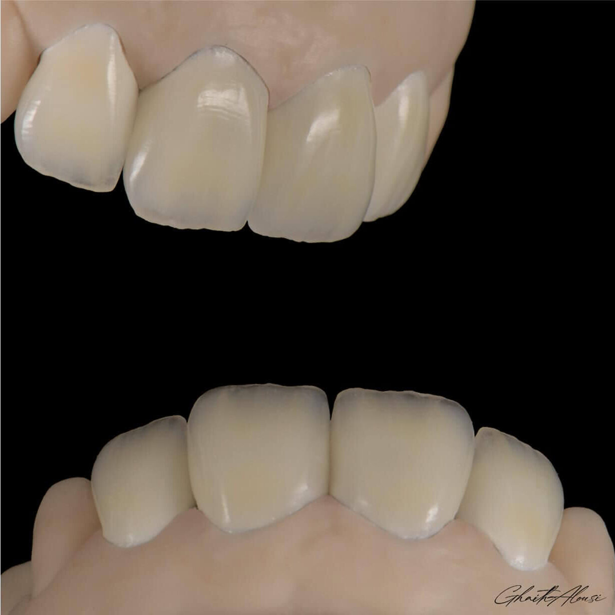 lucrari realizate in laboratorul de tehnica dentara cu discul refractar TriVest cam
