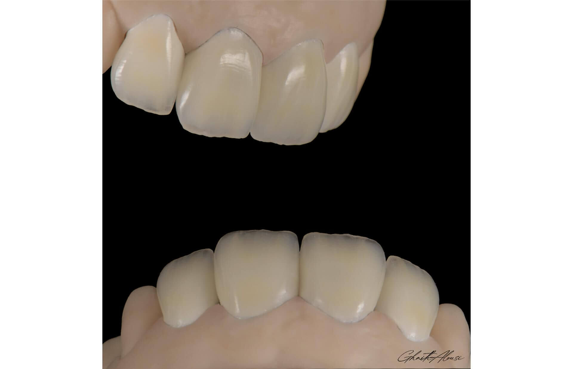 lucrari realizate in laboratorul de tehnica dentara cu discul refractar TriVest cam
