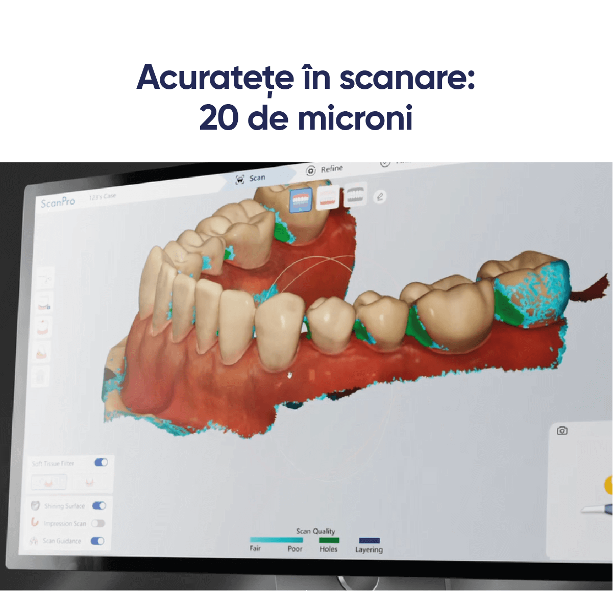 acuratete in scanare intraorala