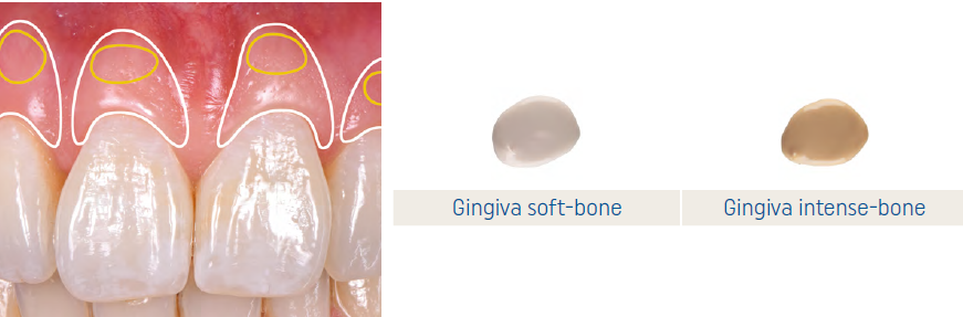 IPS e.max Ceram Art Illusion Gingiva bone