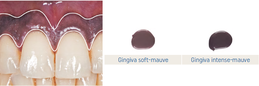 IPS e.max Ceram Art Illusion Gingiva mauve