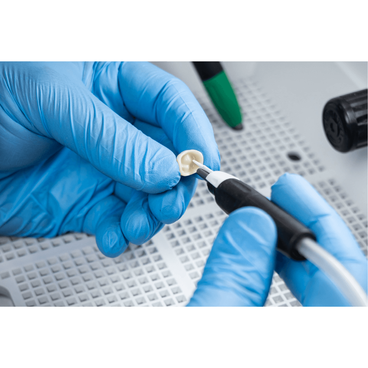 coroana dentara sablata cu prebonder in cabinetul stomatologic