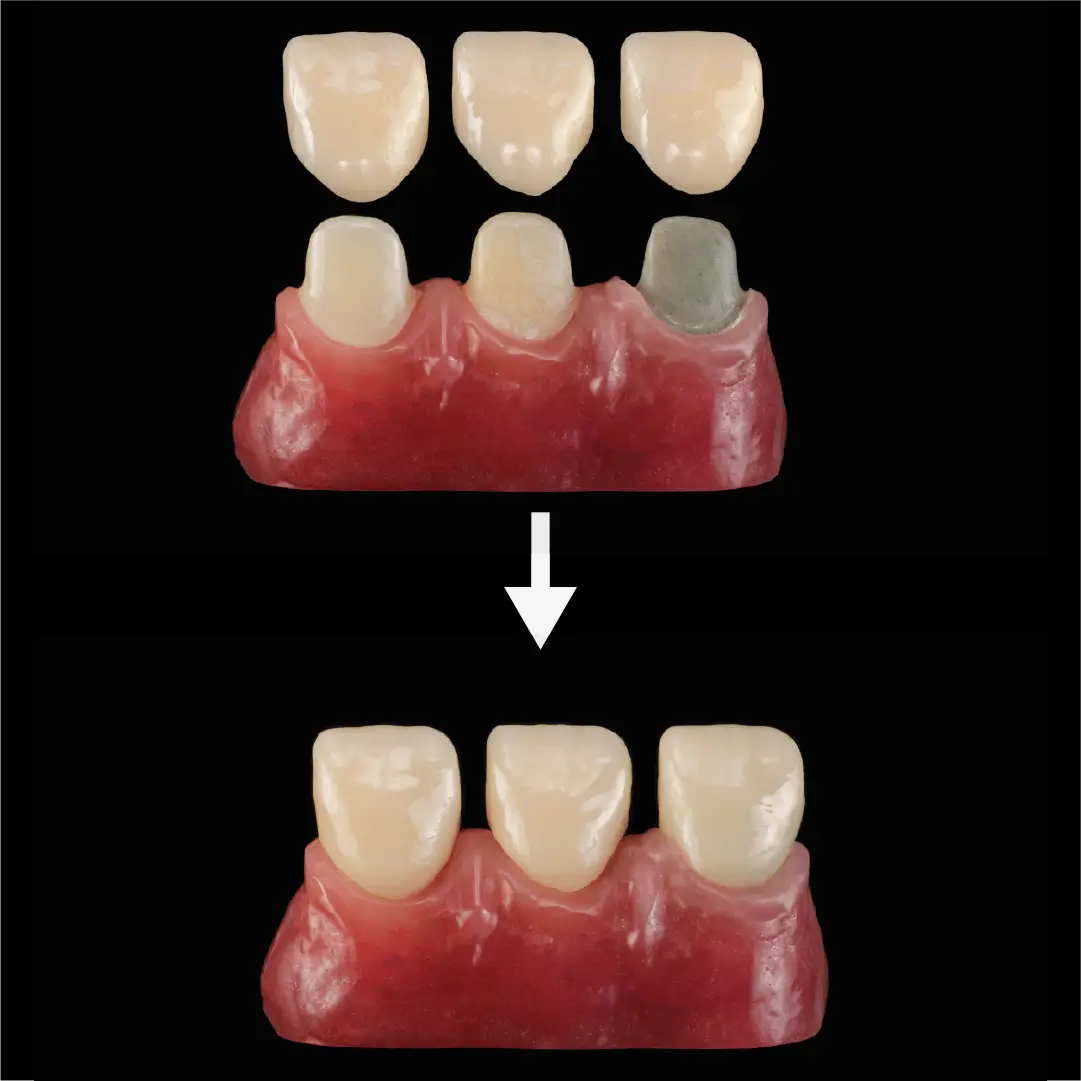 acoperirea bonturilor cu coroane realziate din zirconiu cercon HT ML