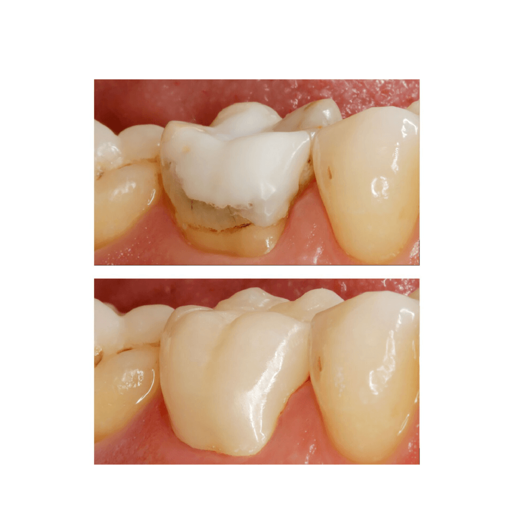 exemplu de restaurare dentara cu IPS e.max zirCAD prime bloc.