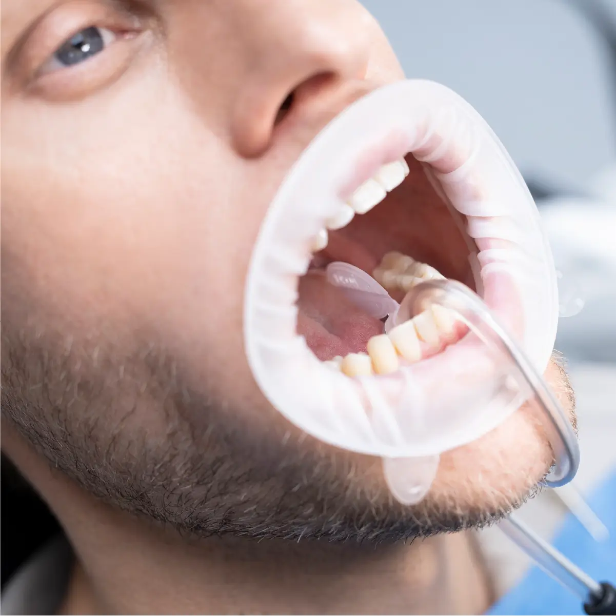 optragate dry control plasat in gura unui pacient