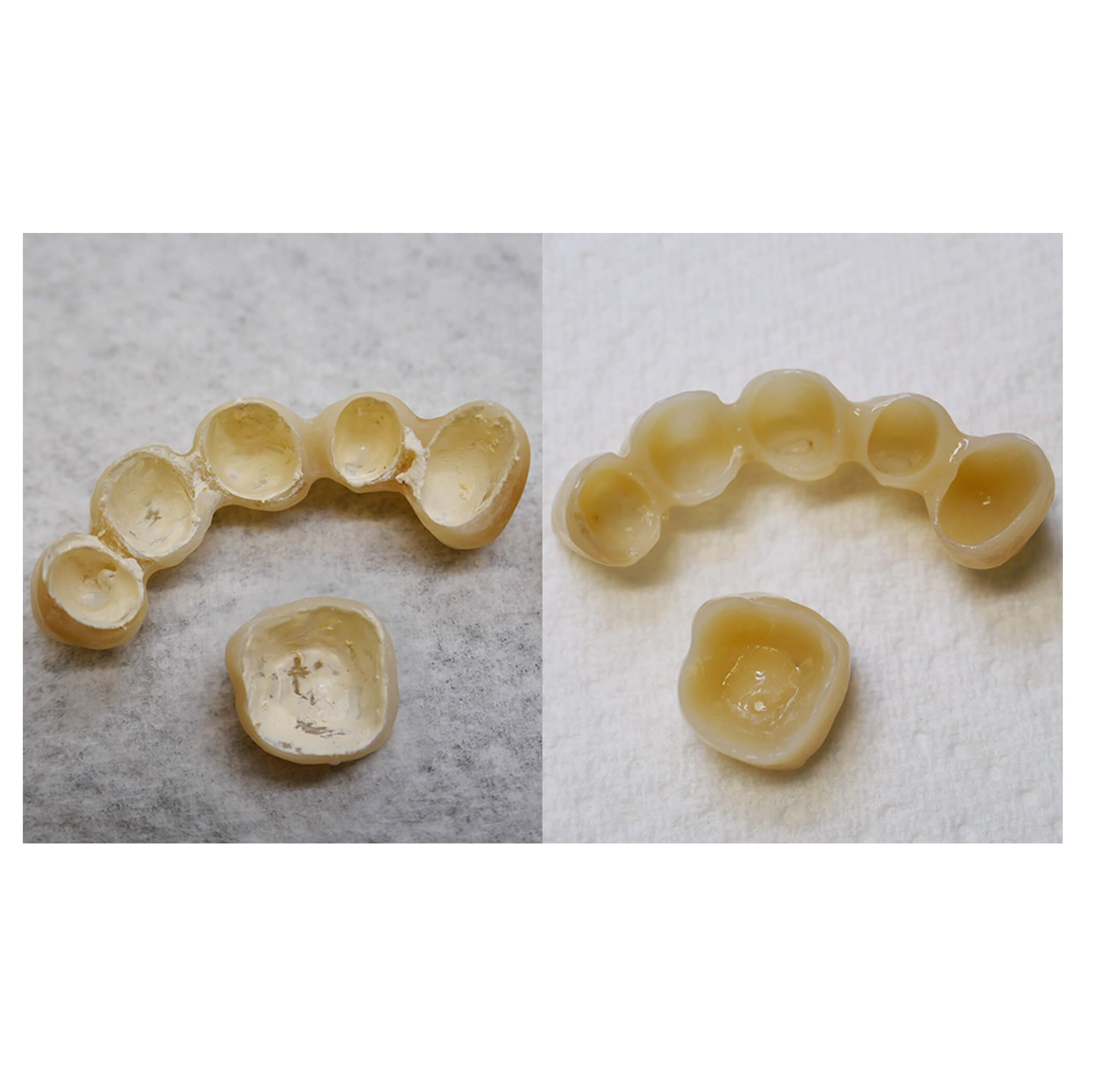 inainte si dupa curatarea cimentului temporar de pe lucrare cu solutia de curatare renfert