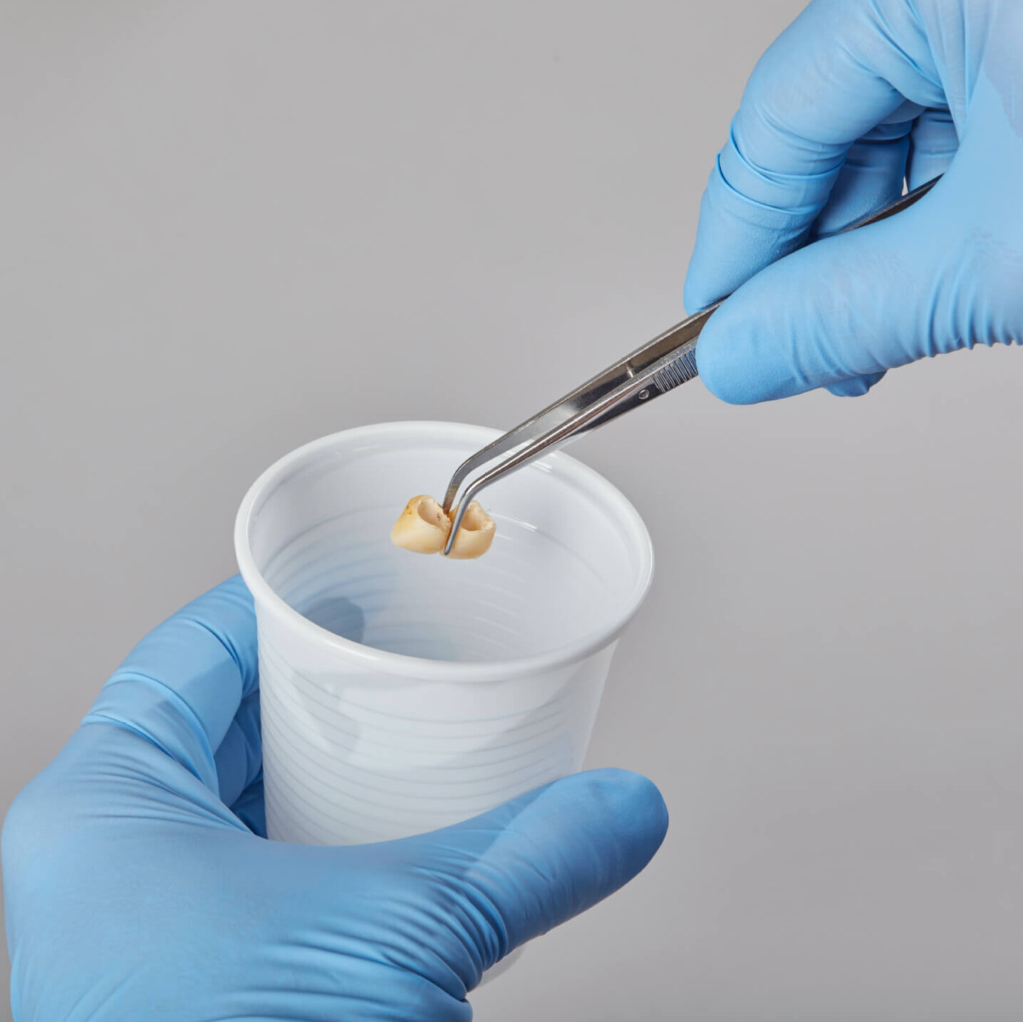 plasarea unei lucrari in pahar pentru a se utiliza solutia de curatare a cimentului temporar renfert