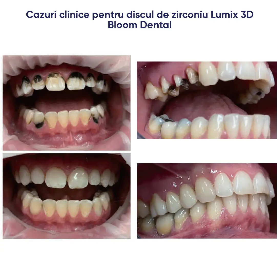 cazuri clinice si exemple de lucrari la care s-a utilizat discul de zirconiu Ultra 3D PRO ML lumix