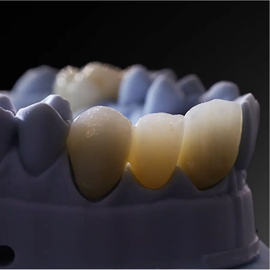 lucrare dentara de aproape in care s-a utilizat discul de zirconiu Ultra 3D PRO ML lumix