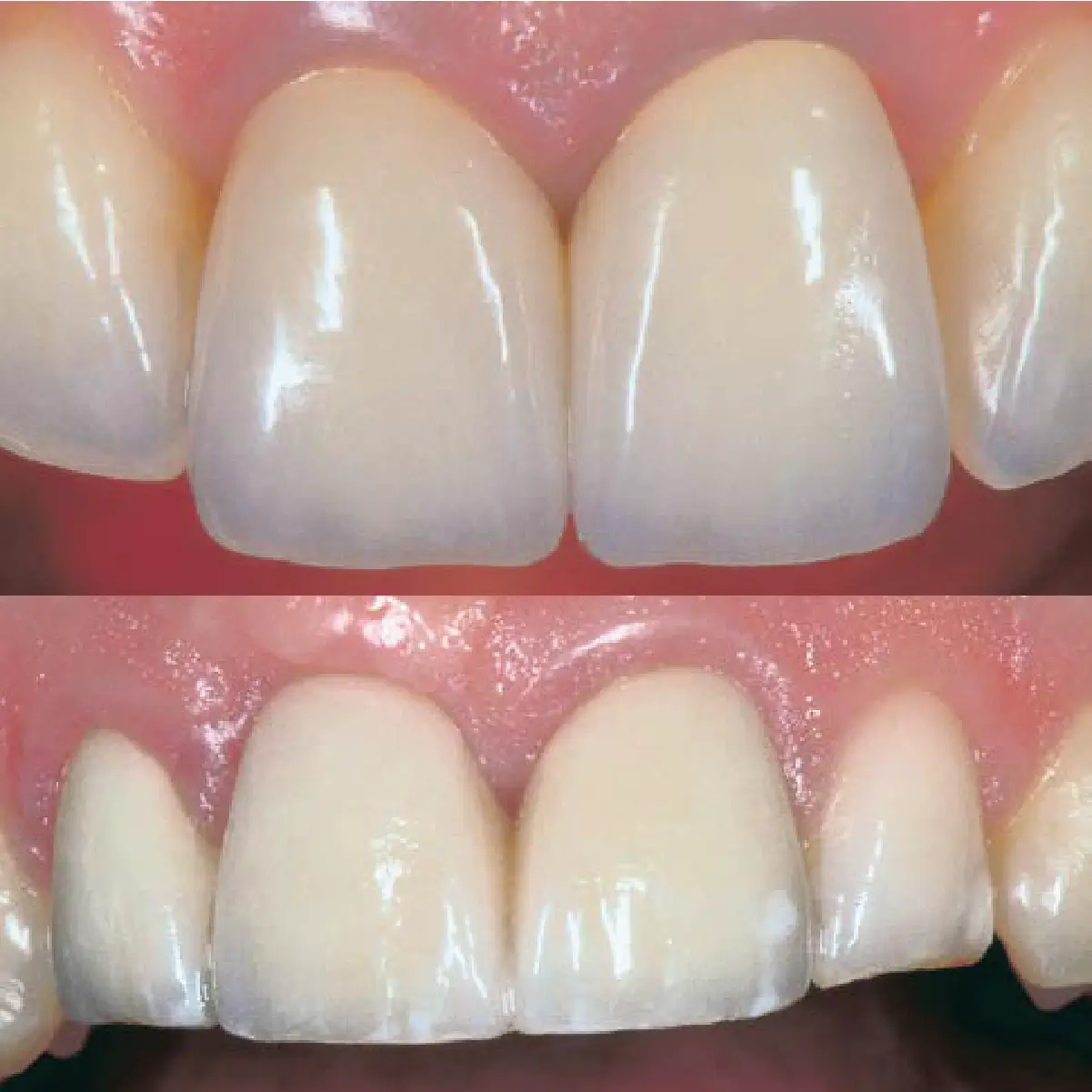 exemplu de lucrari realizate cu ceramica IPS d.sign ivoclar