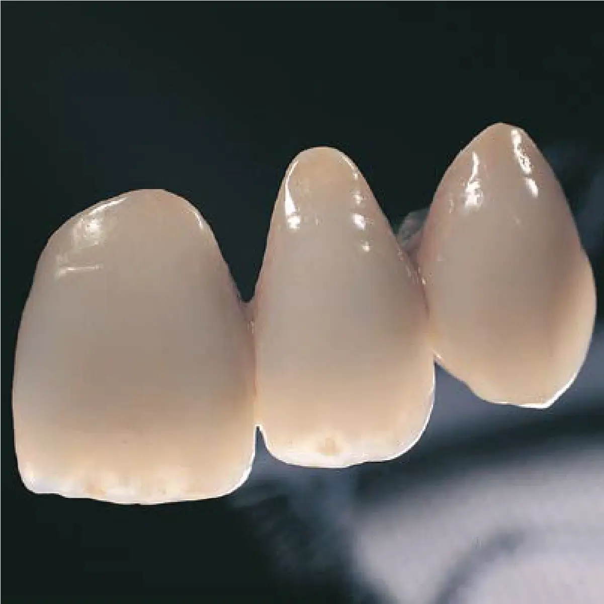 lucrare realizata in laborator de tehnica dentara cu ceramica IPS d.sign