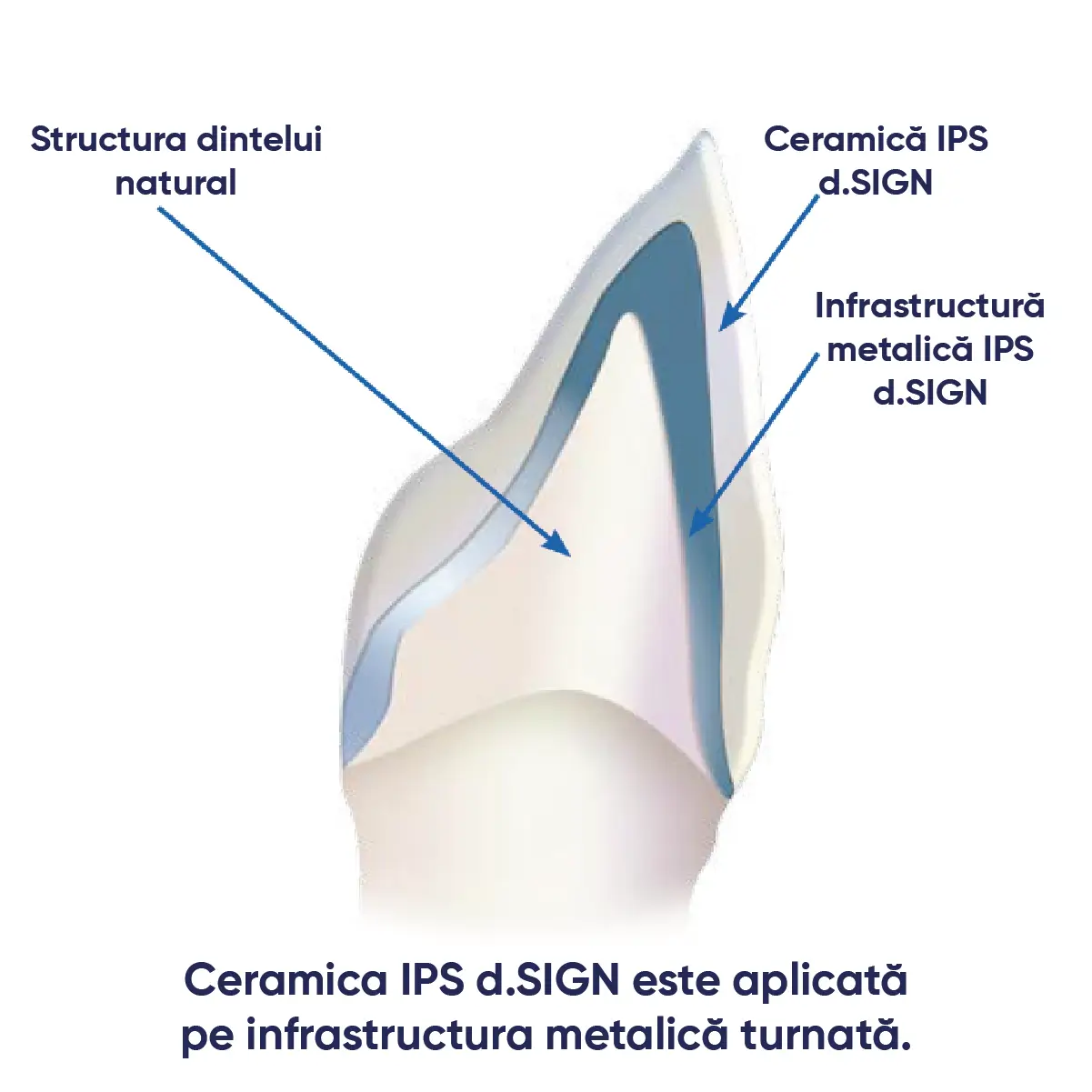 indicatii de utilizare IPS d.sign pentru restaurare
