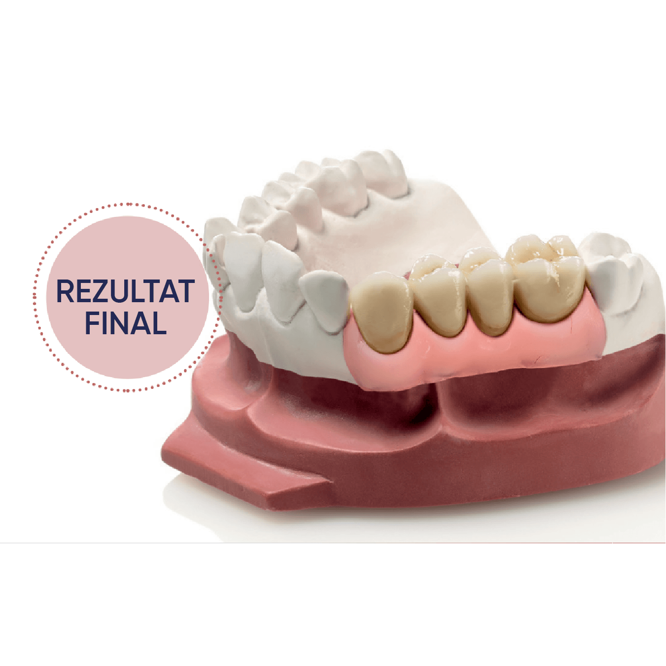 rezultat final pachet gingifast elastic cu lucrare realizata