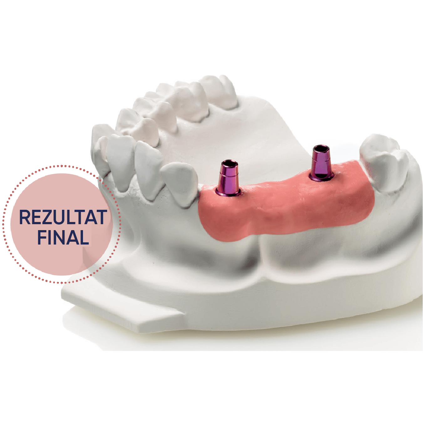 silicon de aditie gingifast rigid cu lucrare realizata alaturi